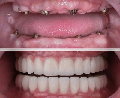 Dental Implants at EverSmile