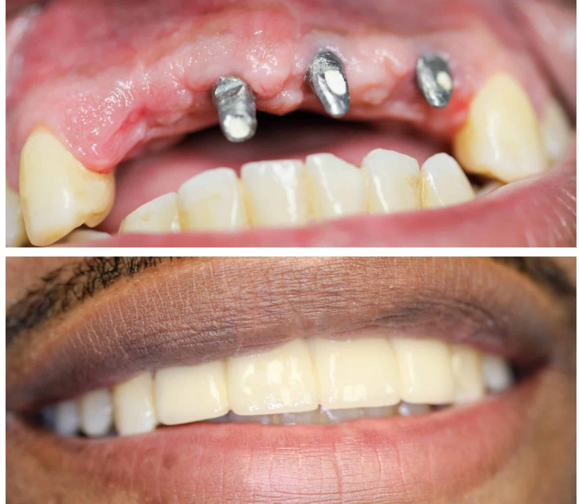 Dental Implants at EverSmile
