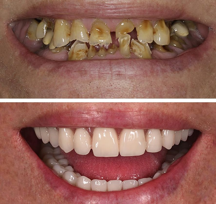 Dental Implants at EverSmile