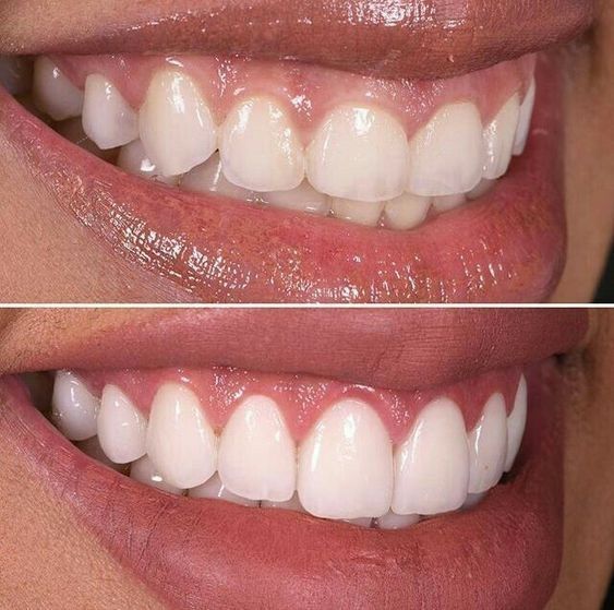 Cosmetic Dentistry at EverSmile