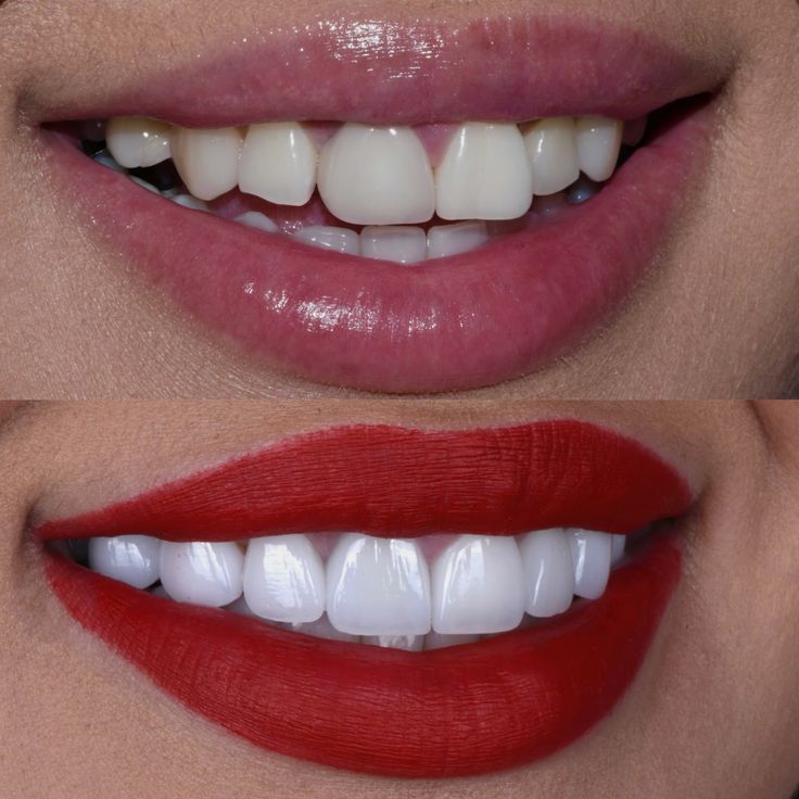Teeth Whitening at EverSmile