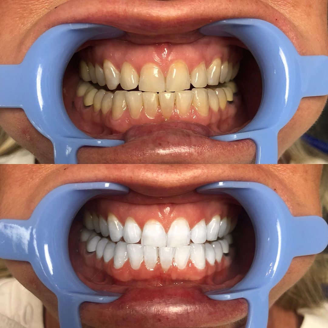 Teeth Whitening at EverSmile