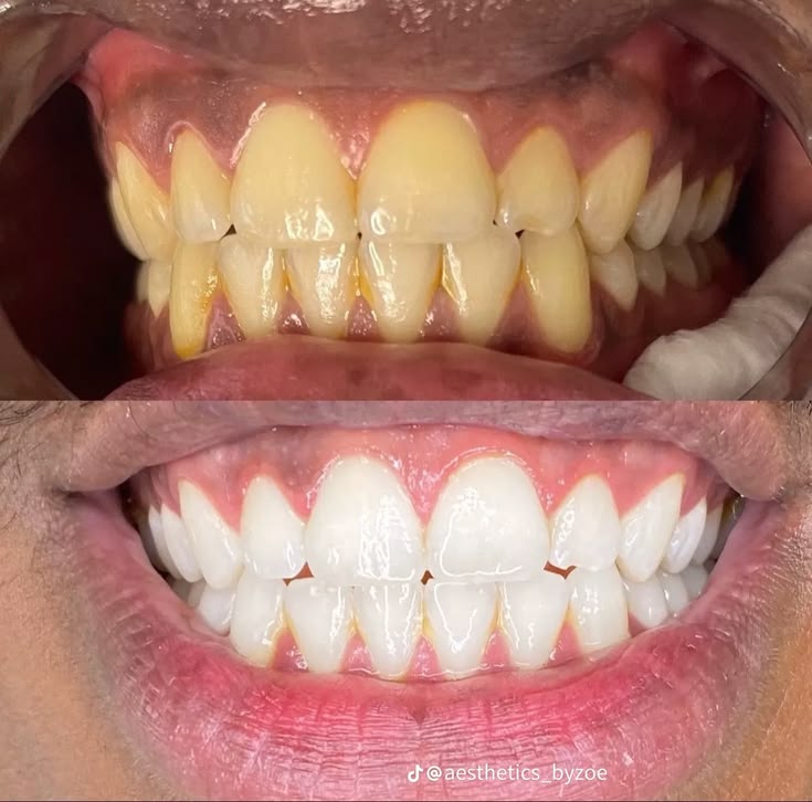 Teeth Whitening at EverSmile